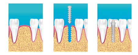 Implantologie dentaire Drancy